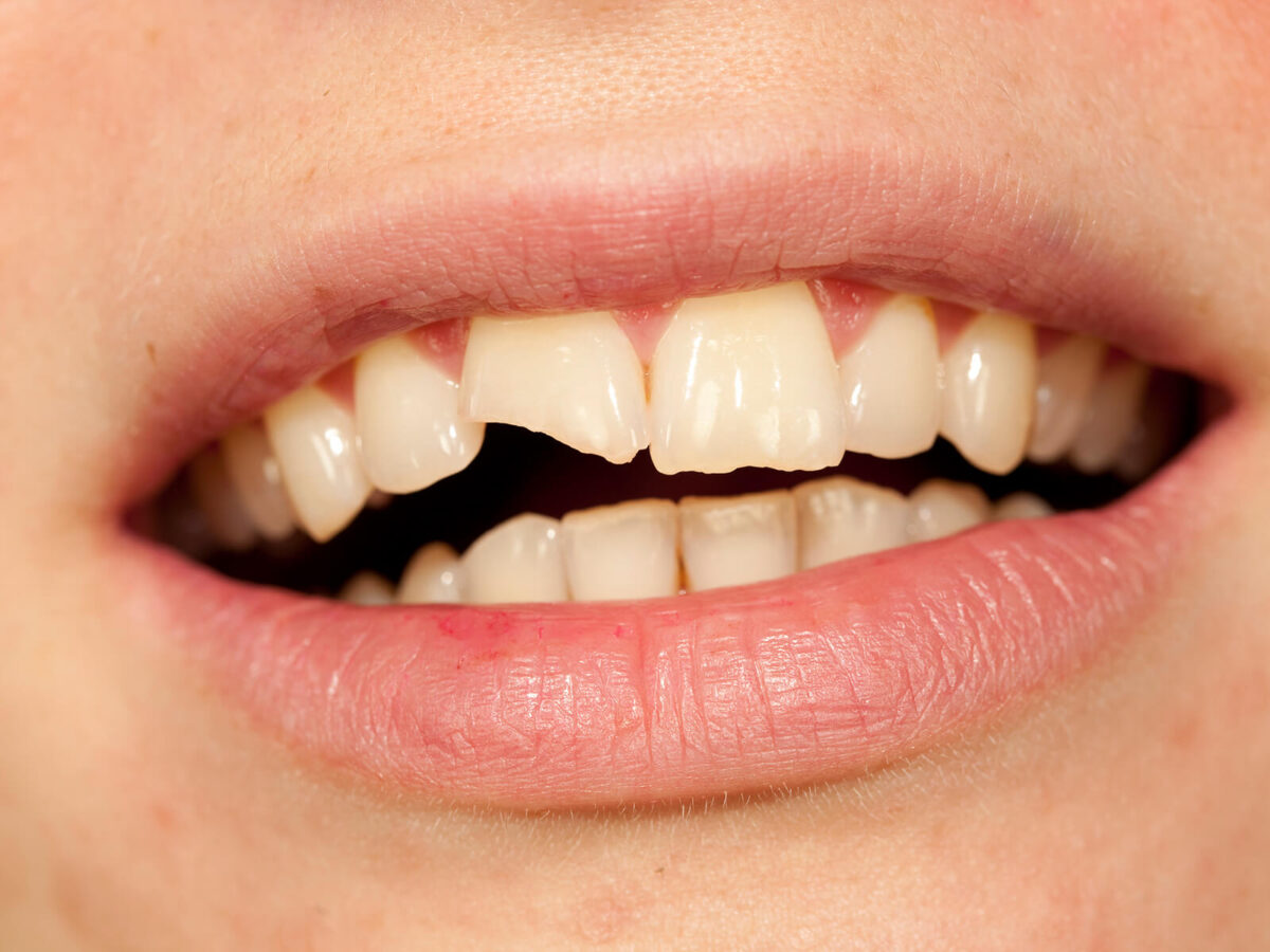 How A Cosmetic Dentist Can Fix Your Chipped or Cracked Teeth