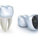 Dental Crowns: Your Solution To Stronger And Healthier Teeth