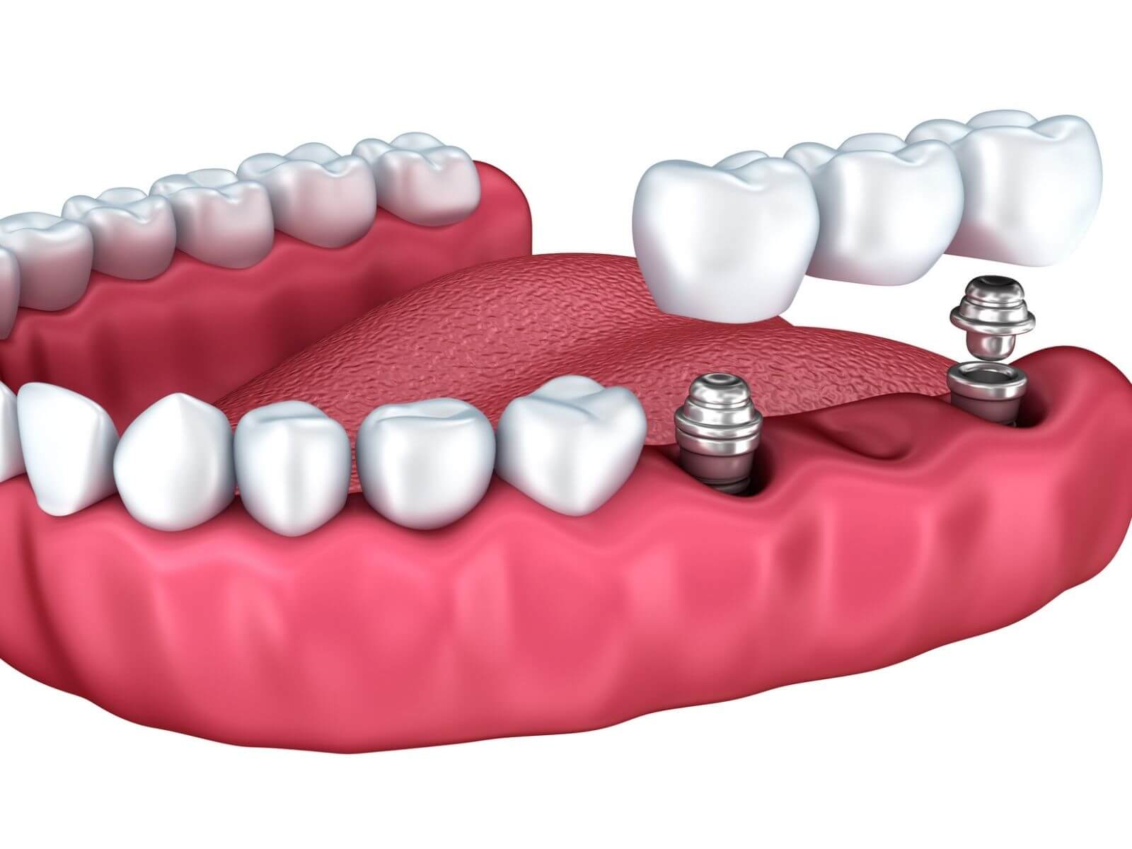 Is It Even Possible For Dental Implants To Get Rusty?