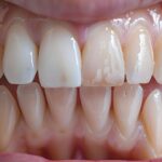 White Spots On Teeth: How To Get Rid of Them